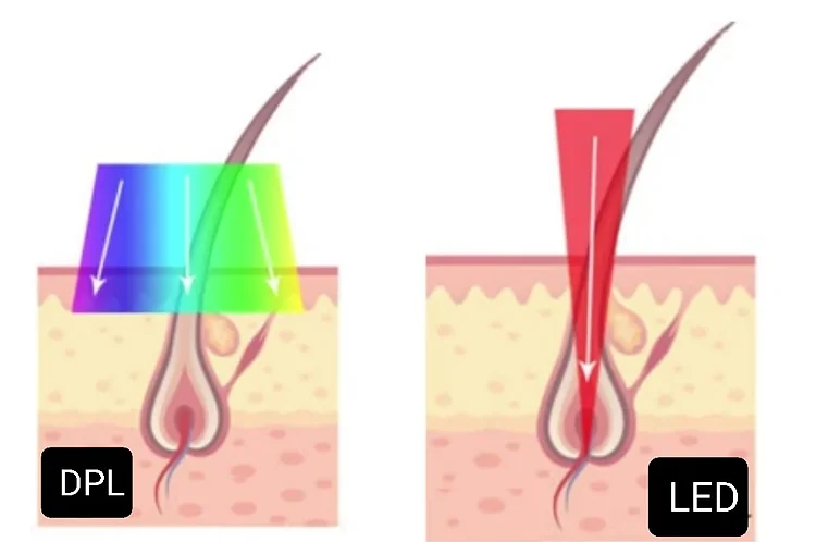 DPL vs Laser Technology