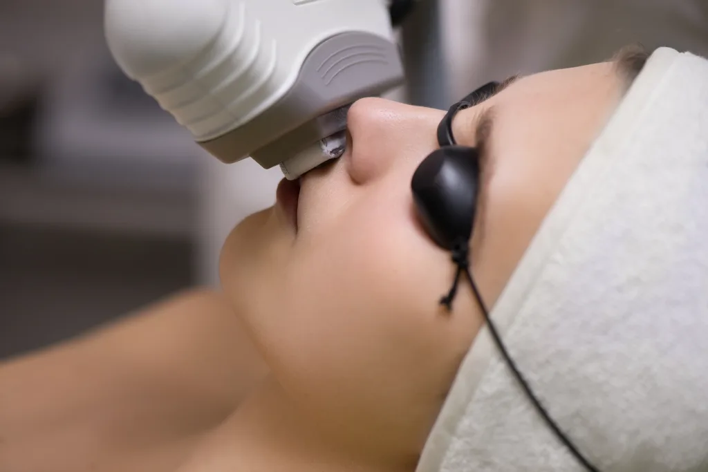 face laser hair removal