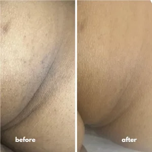 underarms whitening before and after 2