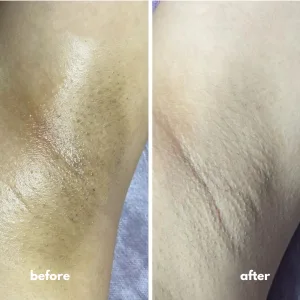 underarms whitening before and after 3