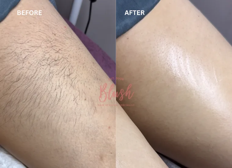 Before after image of permanent hair removal