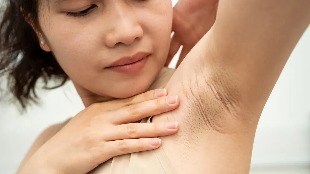 women with dark underarm