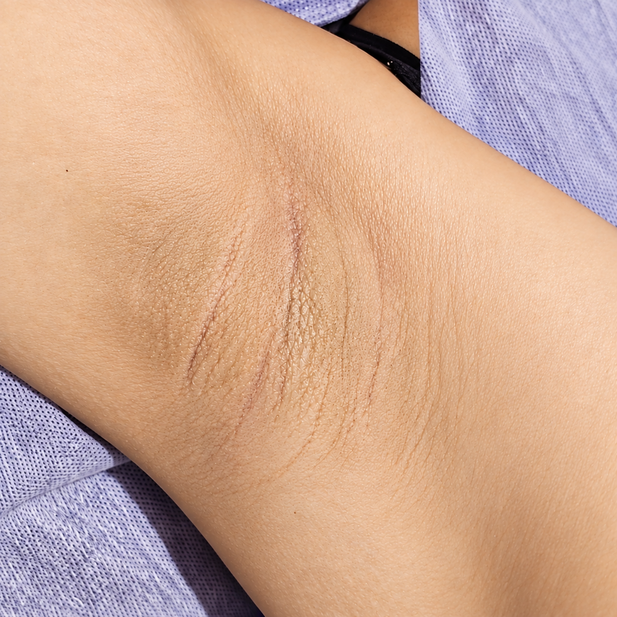 after Underarm whitening treatment at Blush