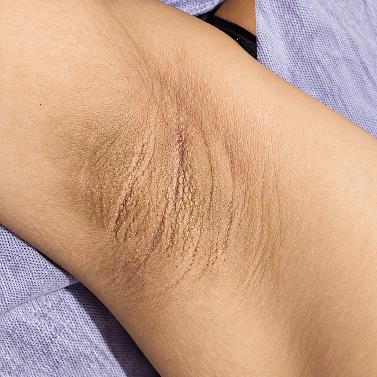 Blush-Before Underarm whitening treatment at Blush Before Underarm whitening treatment at Blush