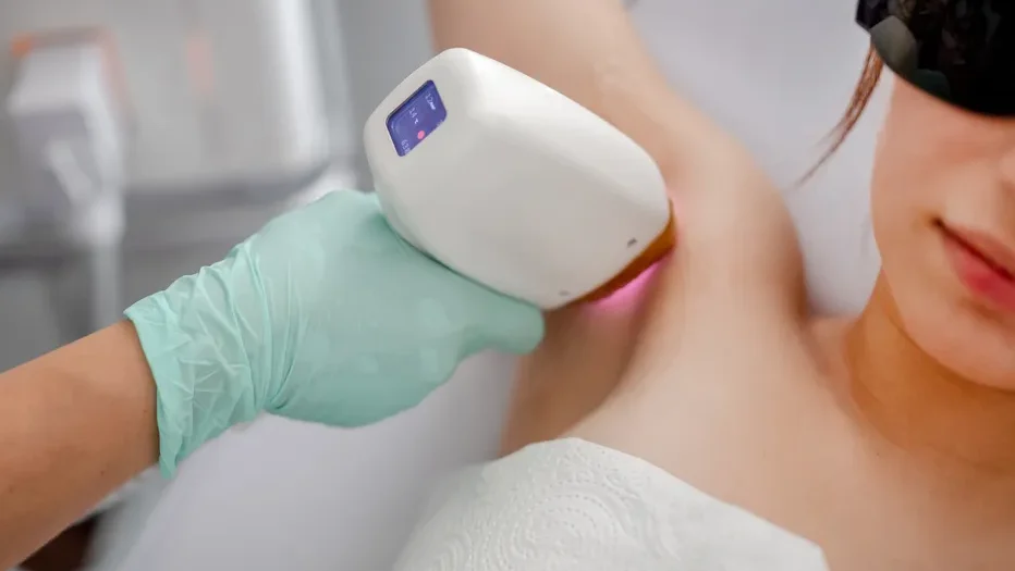 Woman receiving underarm laser hair removal during a treatment session, showing how many laser sessions do I need can vary by body area.