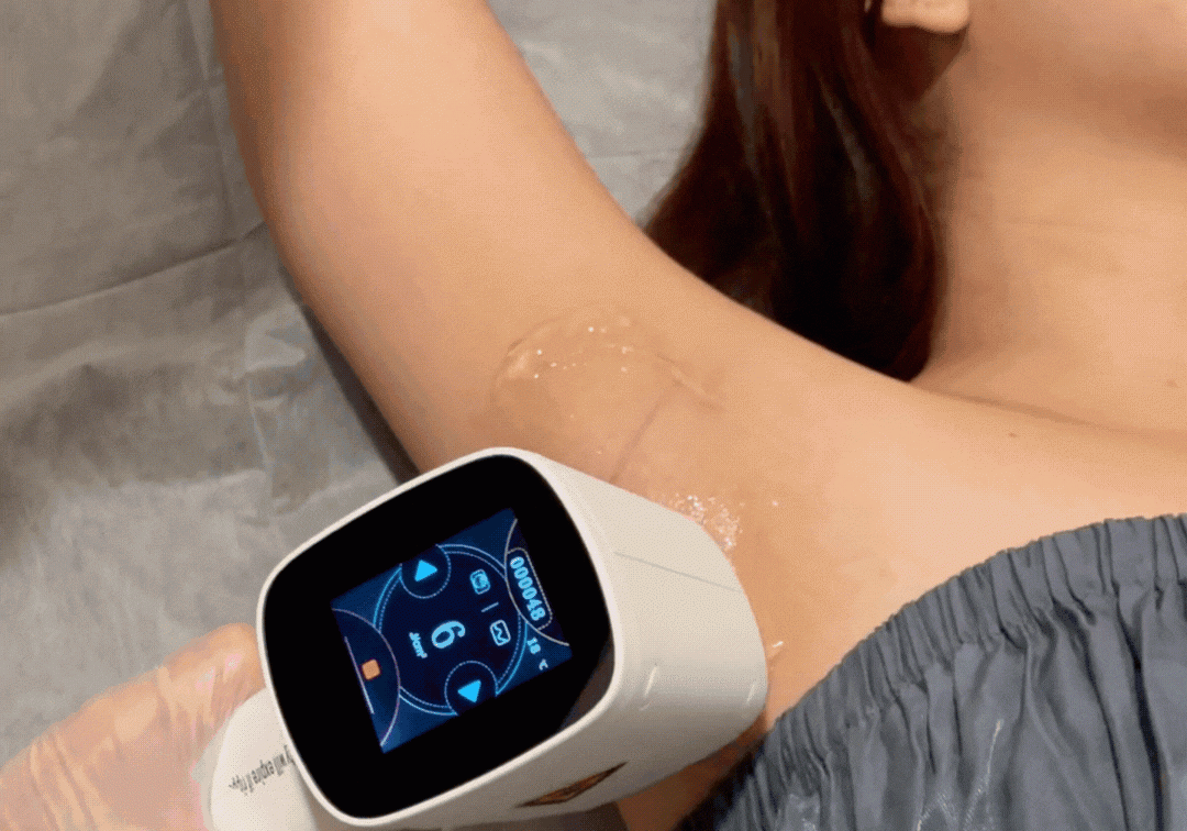 Laser Hair Removal on Underarms